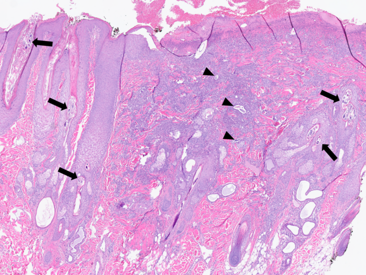H&E stain showing the overlying epithelium is severely ulcerated (right side) with coalescing foci of pyogranulomatous inflammation noted in the dermis. Mites or fragments of mites are visible within or immediately adjacent to distended hair follicles as indicated by arrows on the image.