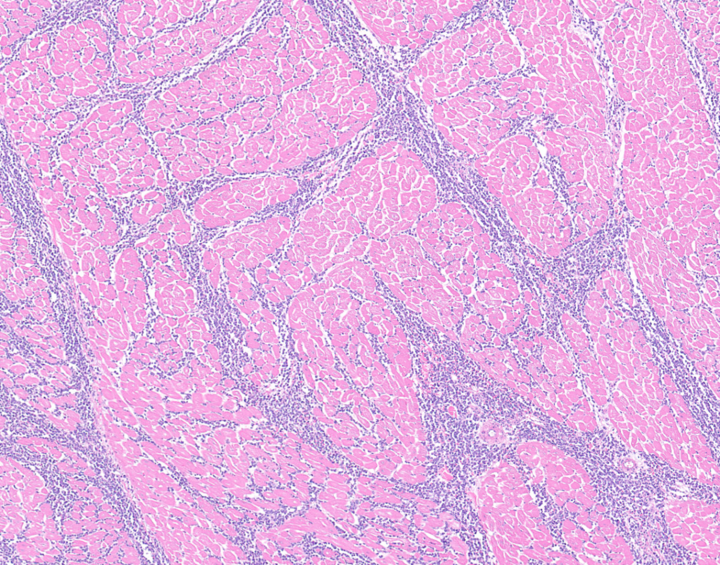 H&E stained section of heart from the cow in this case displaying large numbers of neoplastic lymphocytes infiltrating (and in many cases effacing) the myocardium.