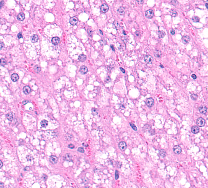 Hepatocytes are often swollen and contain numerous, variably sized, distinct vacuoles within their cytoplasm.